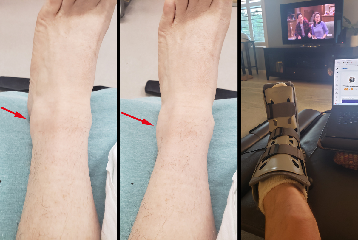broken-ankle.jpg
